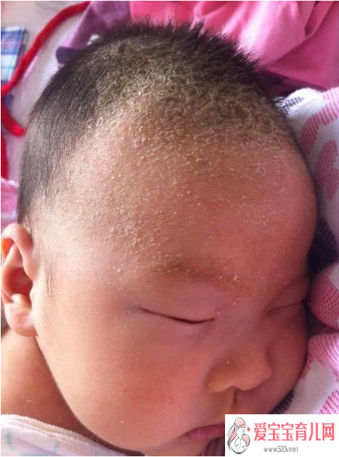 北京供卵代怀男孩_新生儿头上结乳痂怎么回事宝宝头上乳痂怎么清理